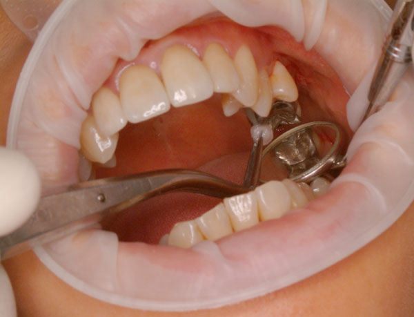 Lakierowanie zębów