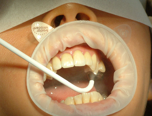 Kiedy przydadzą się implanty zębów